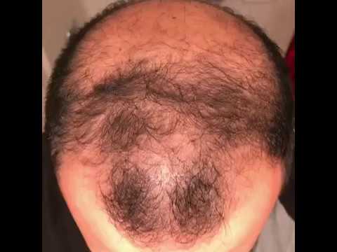 6 months using minoxidil – Rogaine 5% Before & After results