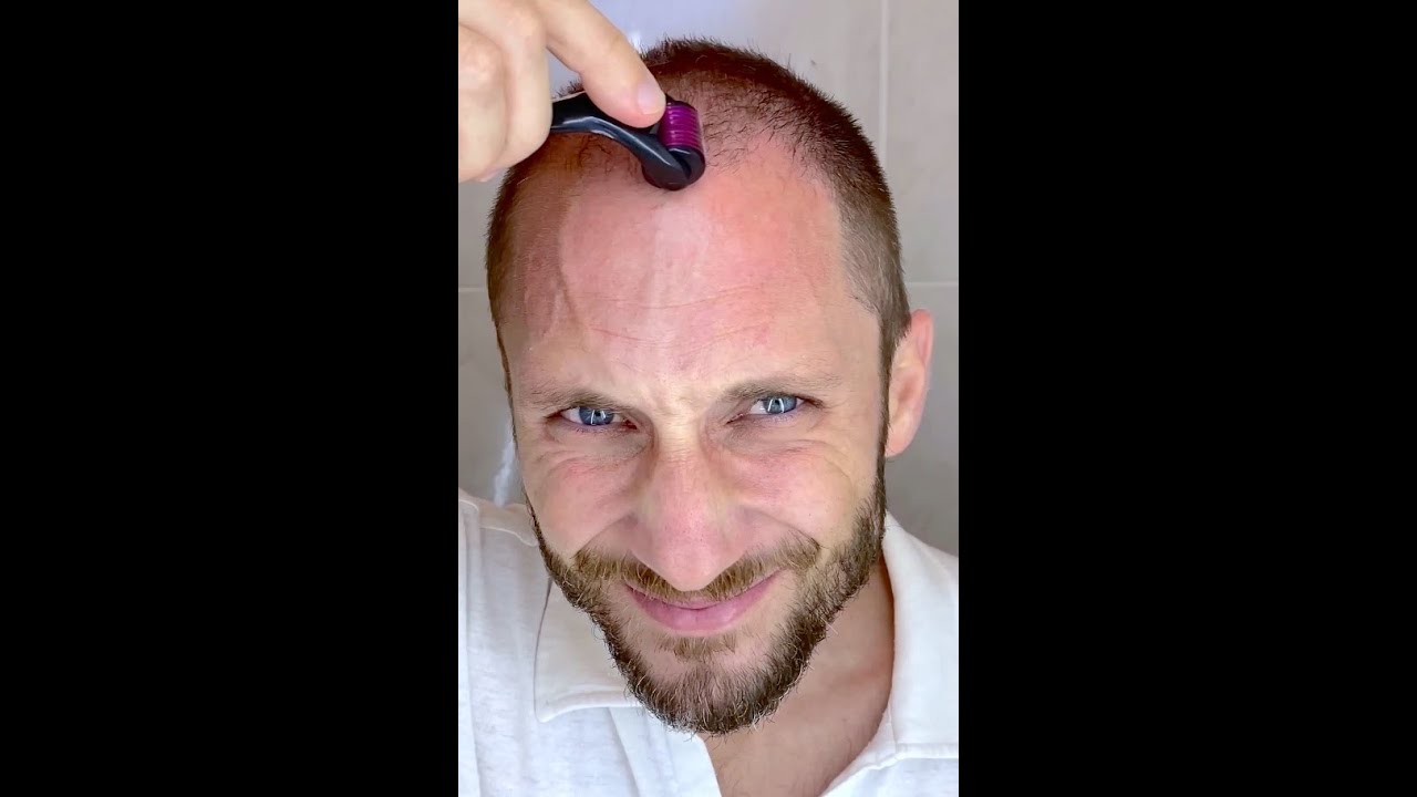 How I Use DermaRoller for Hair Growth and To Solve my Baldness and Hair Loss Tutorial 4k