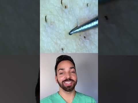 Doctor Reacts to Ingrown Hair #shorts