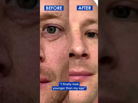 Eyebags Are Gone | Particle Face Cream For Men