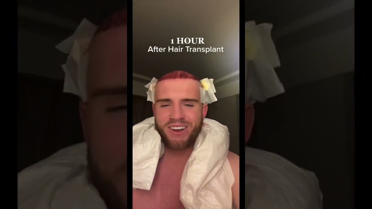 Hair Transplant Results !