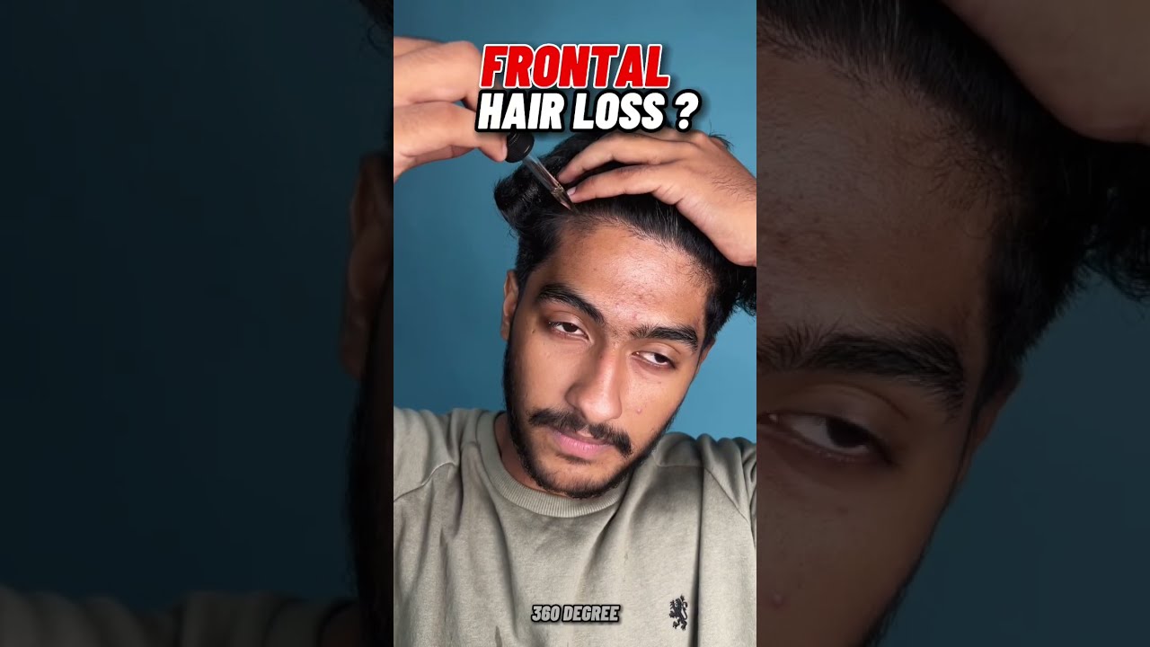 നെറ്റി കയറ്റത്തിനും ഉള്ളു കുറവിനും🔥😱Treatment For Frontal Hair loss And Balding #shorts