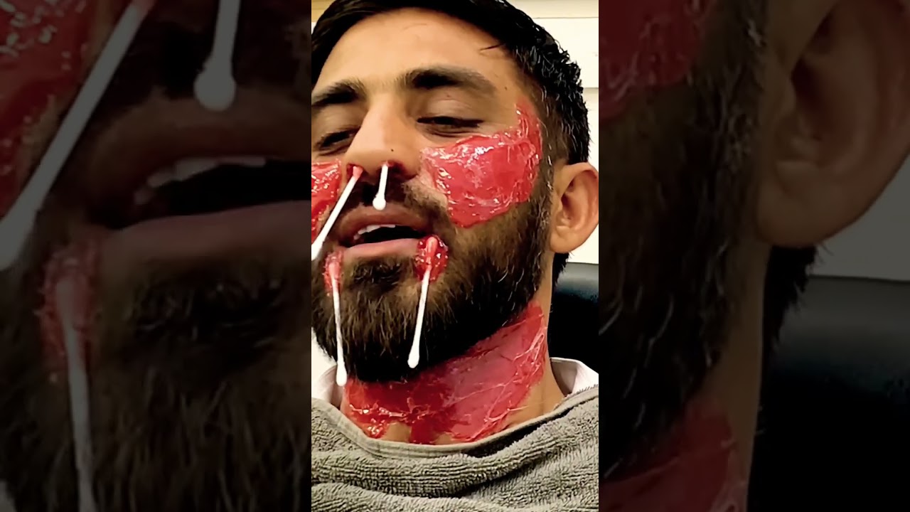 Men waxing for face🙃 / neck Hair remove #waxing #shorts #viral #beard #neck ✂️💈✂️