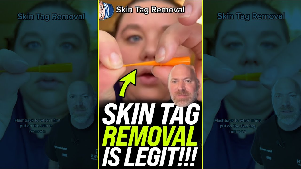 Skin Tag Removal is LEGIT 😱 #shorts