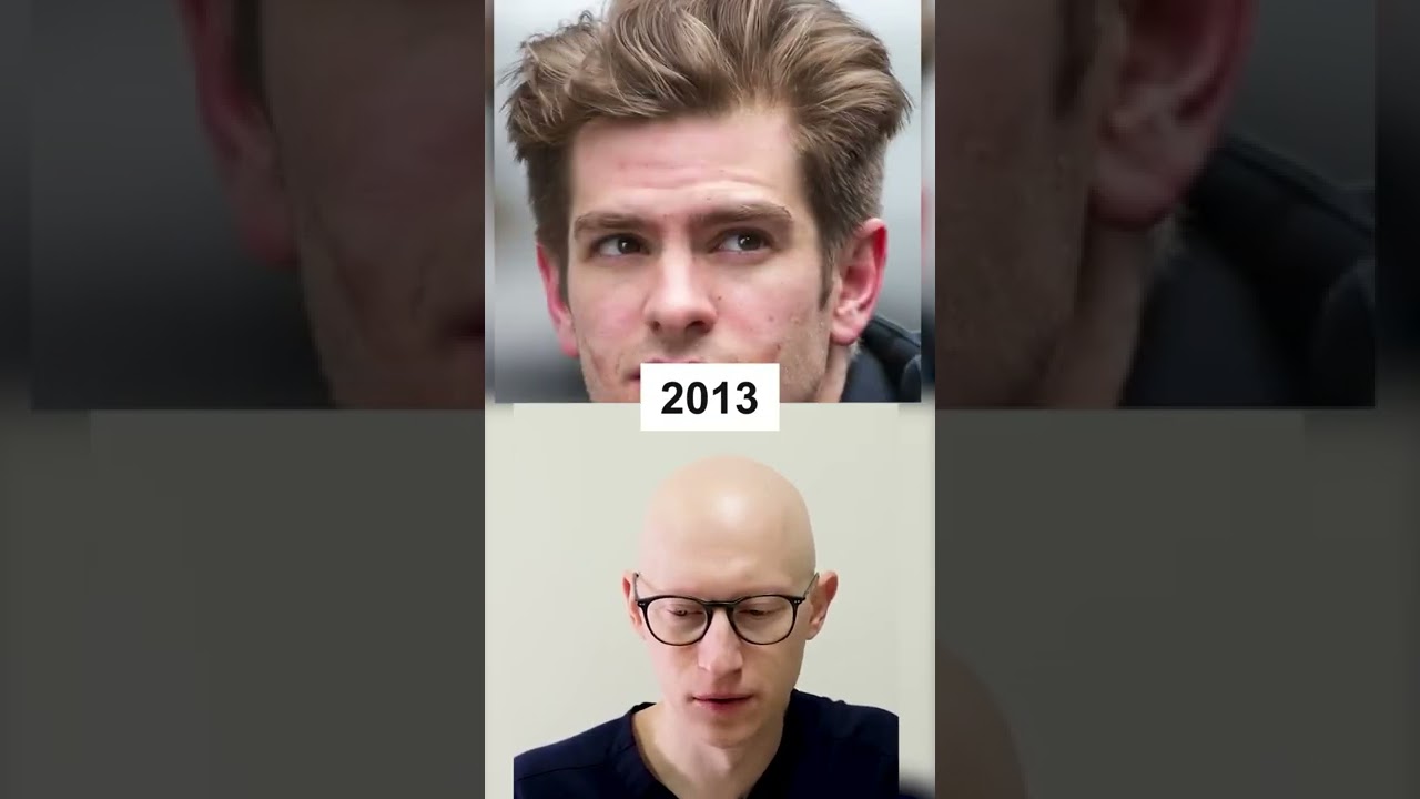 Did Andrew Garfield get a Hair Transplant?