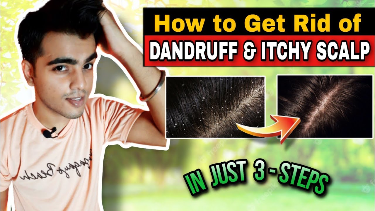 Cure Dandruff & Itchy Scalp In Just 3 – Steps ✅😊 #shorts #haircare #dandruff