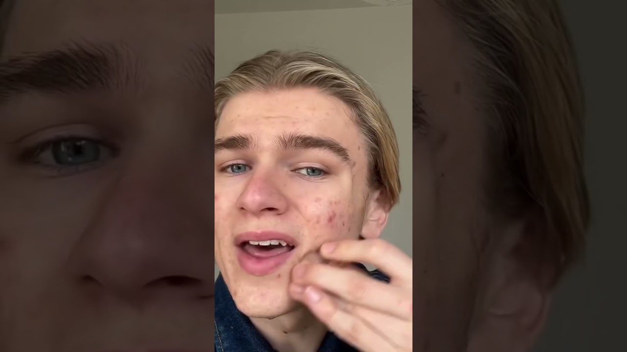 How to cover your acne as a guy